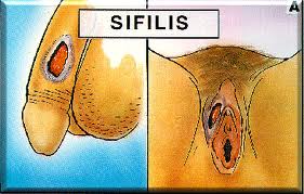 Hasil gambar untuk sifilis